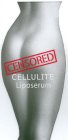 CENSORED CELLULITE LIPOSERUM