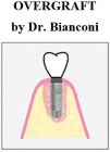 OVERGRAFT BY DR. BIANCONI