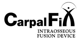 CARPALFIX INTRAOSSEOUS FUSION DEVICE